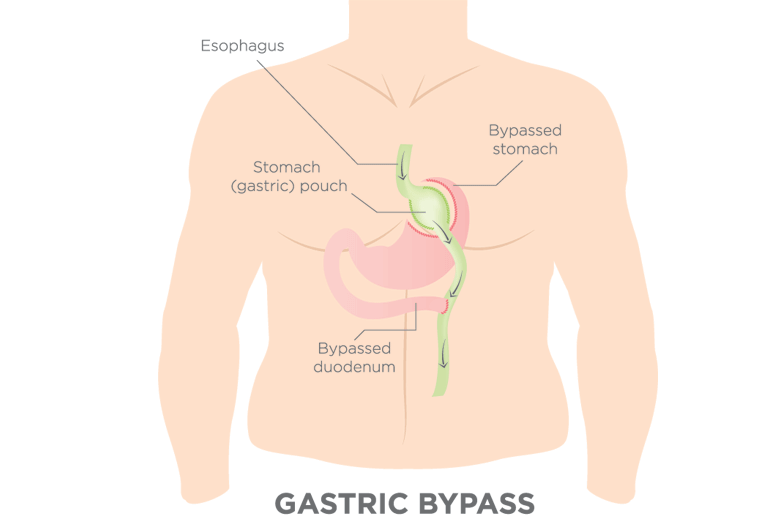 gyomor bypass